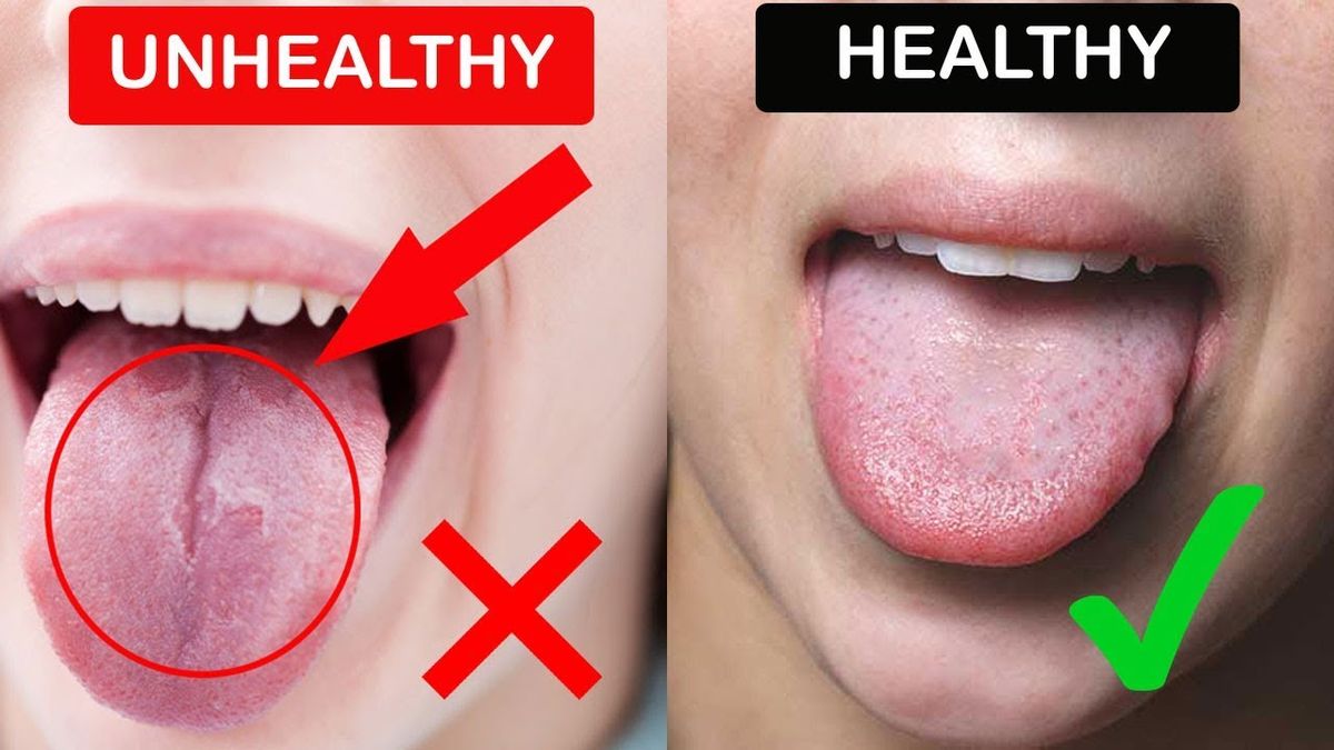 VsWLZ31NtFA Healthy And Unhealth Tongue 